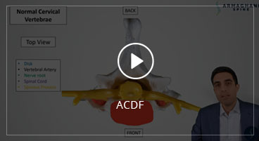 ACDF (Anterior Cervical Diskectomy and Fusion)