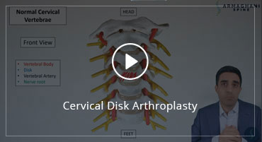 Cervical Disk Arthroplasty