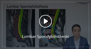 Lumbar Spondylolisthesis