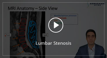 Lumbar Stenosis