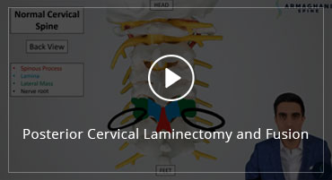 Posterior Cervical Laminectomy and Fusion