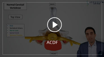 ACDF