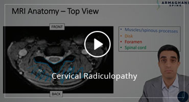 Cervical Radiculopathy