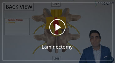 Laminectomy