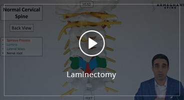 Laminectomy