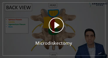 Microdiskectomy