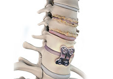 Adjacent Segment Disc Disease