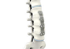 Anterior Lumbar Corpectomy and Fusion