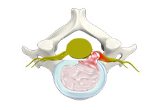 Cervical Disc Herniation