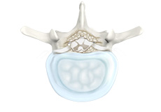 Degenerative Spinal Conditions