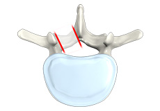 Posterior Cervical Foraminotomy