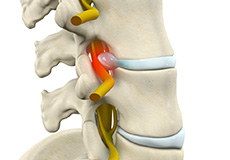 Lumbar Radiculopathy