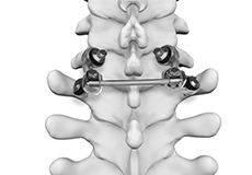 Motion Preservation Spine Surgery