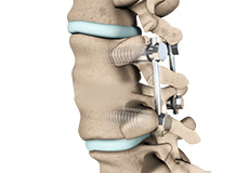 Oblique Lumbar Interbody Fusion (OLIF)