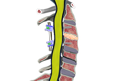 Pseudarthrosis/Nonunion