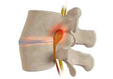 Lumbar Stenosis