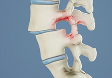 Lumbar Spondylolisthesis