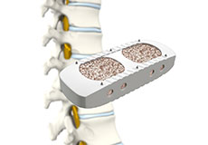 XLIF - Extreme Lateral Interbody Fusion